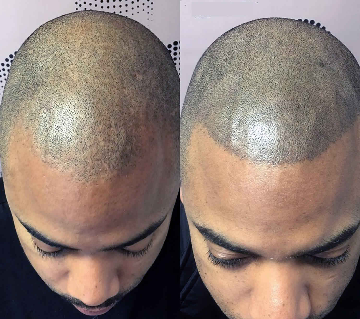 Knowing Details about Scalp Micropigmentation Training